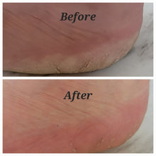Load image into Gallery viewer, Solution for foot crack split in heel how to heal